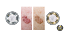 Dermatoskop LuxaScope  CCT LED 2.5 V - diagnostika při použití studeného a teplého světla Dermatoskop LuxaScope CCT LED 2.5V, bílý, se stupnicí