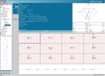 Modul slovní interpretace HES analýzy EKG záznamu