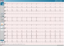 Klidové EKG PADSY-ECG - náběr EKG křivky Klidové PC-EKG PADSY-EKG s interpretací HES